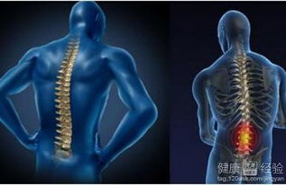 強(qiáng)直性脊柱炎的治療與管理 一個(gè)全面指南