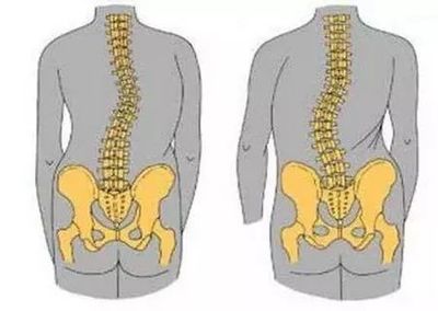 打破遺傳宿命 如何科學(xué)降低強(qiáng)直性脊柱炎的患病風(fēng)險(xiǎn)