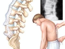 強(qiáng)直性脊柱炎治療費(fèi)用解析 從診斷到長(zhǎng)期管理需要多少錢(qián)？